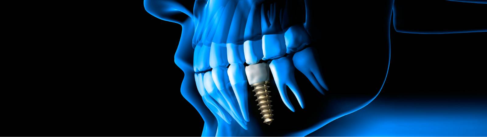 Implantes